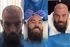 Joe-Ledley-hair-transplant.jpg